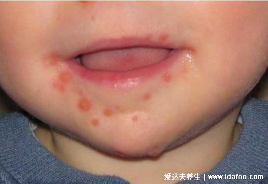 小孩口足手病轻微图片，出现感冒症状然后长红疹和疱疹(警惕重症)