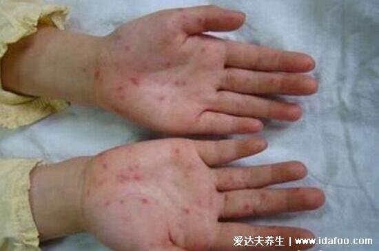 小孩口足手病轻微图片，出现感冒症状然后长红疹和疱疹(警惕重症)