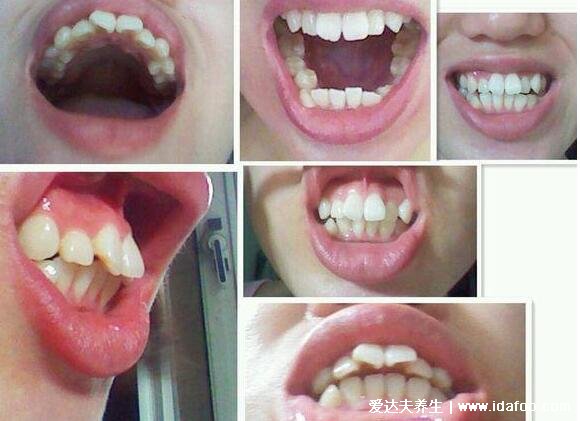 5类人不能做牙齿整形，牙周病/出血性疾病/急性传染病患者