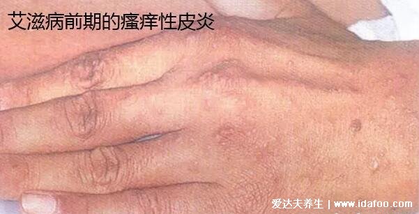 艾滋病初期小红点照片，早期的瘙痒性皮炎伴随皮肤溃烂(附自查法)