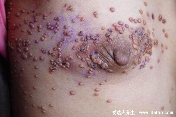 艾滋病初期小红点照片，早期的瘙痒性皮炎伴随皮肤溃烂(附自查法)