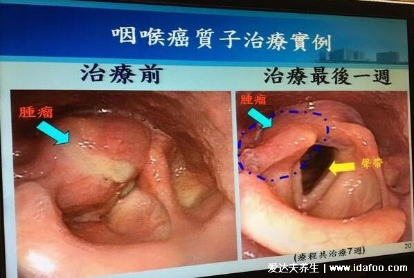 女性咽喉癌的早期症状，五大早期症状明显感觉咽喉有异物(图片)