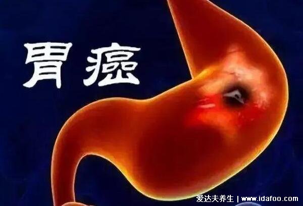 胃癌的五大早期症状，和胃炎相似/吐血黑便(胃癌早期舌头图片)