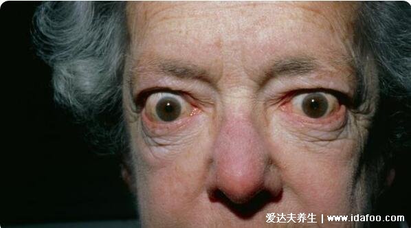 甲亢症状有哪些症状，眼球突出视力减退(4大症状)