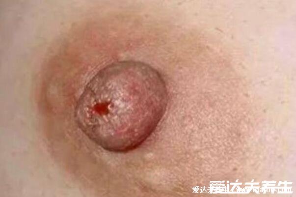 乳腺癌晚期能活多久，乳腺癌早期症状图片