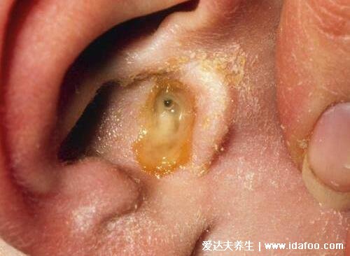中耳炎症状有哪些表现，耳痛流脓听力下降伴随全身症状(图片)