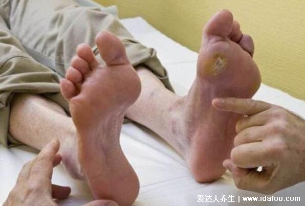 4大糖尿病足的早期症状图片，双脚脱皮伴随刺痛最后麻木(避免截肢)