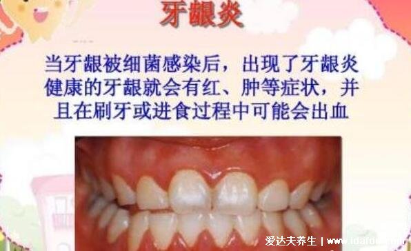 牙龈出血是什么病征兆，不一定是大病不要担心(大概率是牙龈炎)