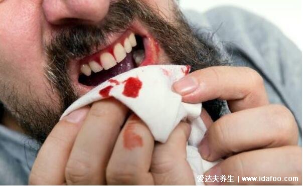 牙龈出血是什么病征兆，不一定是大病不要担心(大概率是牙龈炎)