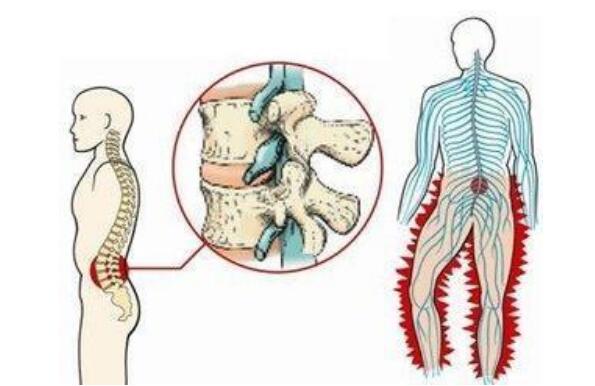 腰椎间盘突出压迫神经腿疼怎么治，药物和保守疗法一般不需要手术