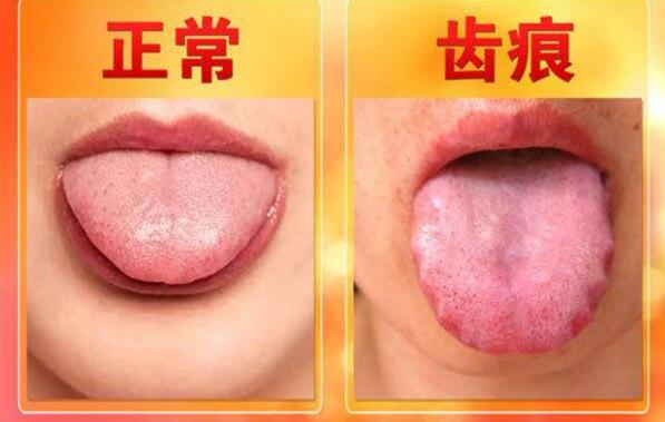 舌头边缘有齿痕是什么原因怎么调理，湿气太重加上胃火旺盛