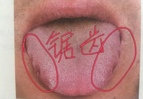 舌头边缘有齿痕是什么原因怎么调理，湿气太重加上胃火旺盛