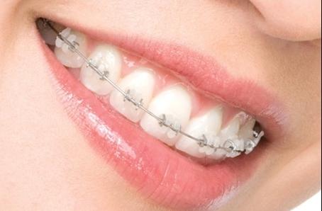 5类人不能做牙齿整形，这几种人千万慎重整牙