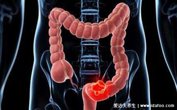直肠癌早期的5大症状，左下腹肛门隐隐作痛伴随大便变细带血