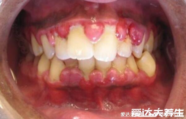 牙龈癌的早期三大症状，口腔溃疡/牙齿松动/长菜花样的肿物