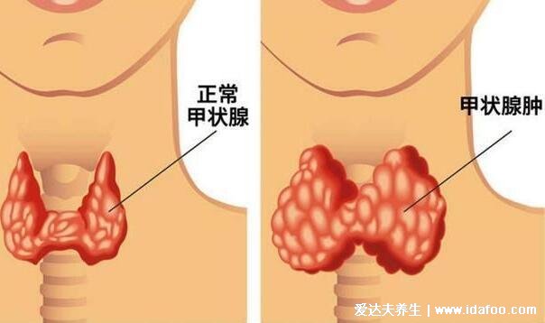 甲状腺的主要症状图片，警惕：明明吃的多体重却在下降