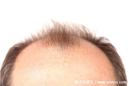 脂溢性脱发是身体哪里出问题了，体内的雄激素分泌过多