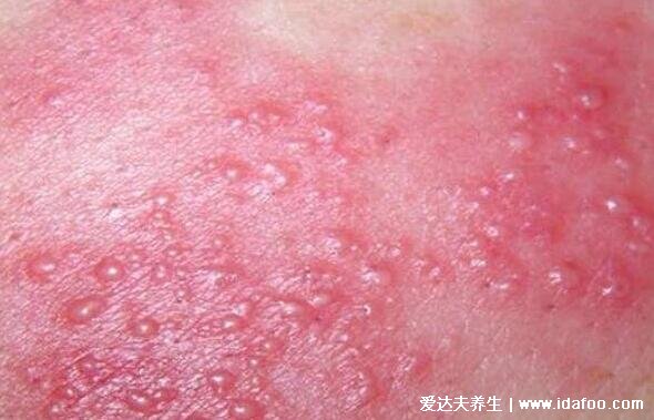 水痘初期小红点图片，从红点很快变成水泡(附水痘的7天演变过程图片)
