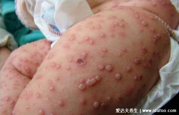 水痘初期小红点图片，从红点很快变成水泡(附水痘的7天演变过程图片)