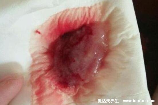 真实掉出来的子宫内膜图片，像血块摸起来有肉感(附血块孕囊区别图)