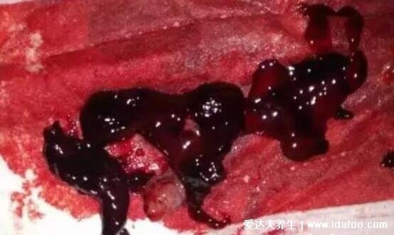 真实掉出来的子宫内膜图片，像血块摸起来有肉感(附血块孕囊区别图)