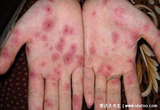 梅毒小红点早期图，不痛不痒的从生殖器蔓延至全身
