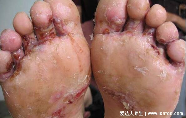 三种类型脚气的图片及症状，水疱型最痒/角化型最难治(附根治法)
