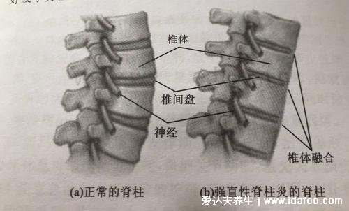 强直性脊柱炎6个地方疼，腰背痛胸痛还有神经痛