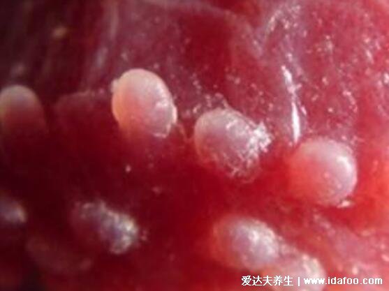 早期珍珠状丘疹图片及症状，不是X病不会传染和尖锐湿疣很像