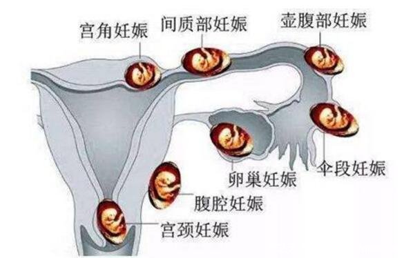 为什么会宫外孕，宫外孕的症状有哪些表现(4大原因)