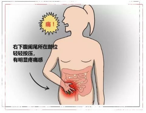 阑尾炎是哪个部位疼，阑尾炎的疼痛位置图片症状