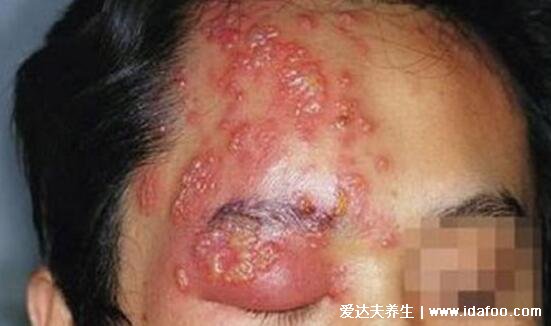 带状疱疹最危险的三个部位，面部/耳朵/外阴肛周引起严重并发症(附图片)