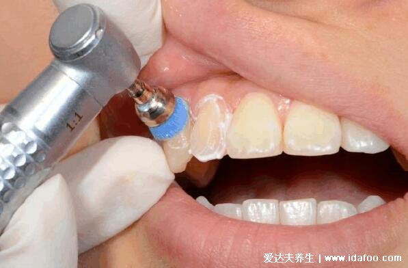 为什么很多人洗牙会有牙裂，牙齿本身就有的牙隐裂与洗牙无关