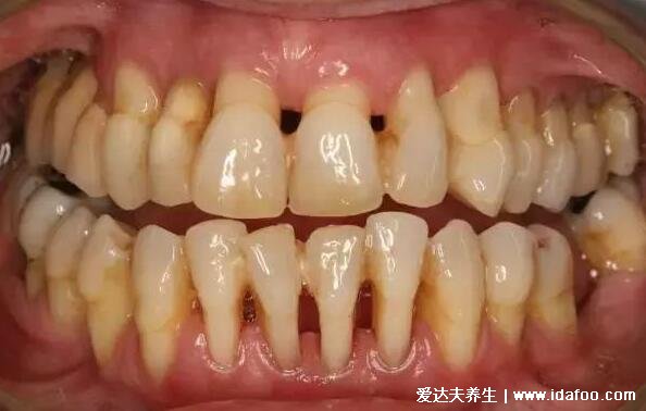 洗牙后悔一輩牙齦萎縮怎么辦，定期洗牙能預防牙齦萎縮更嚴重