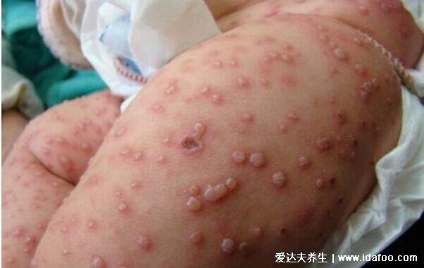 怎么判断是不是水痘，水痘的症状和图片(附7天演变过程图)