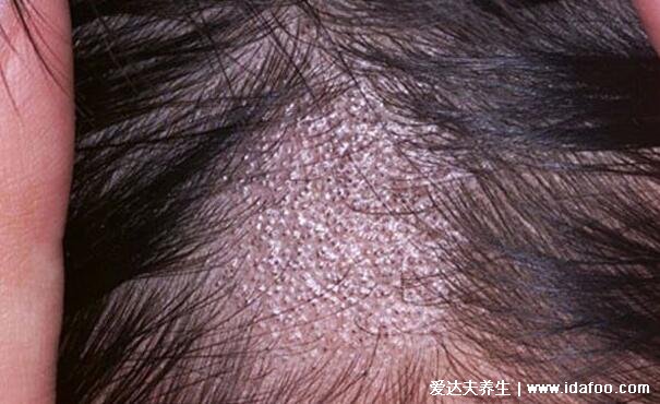 早期头皮癣症状图片，4种类型中黄癣传染性强脓癣永久性脱发