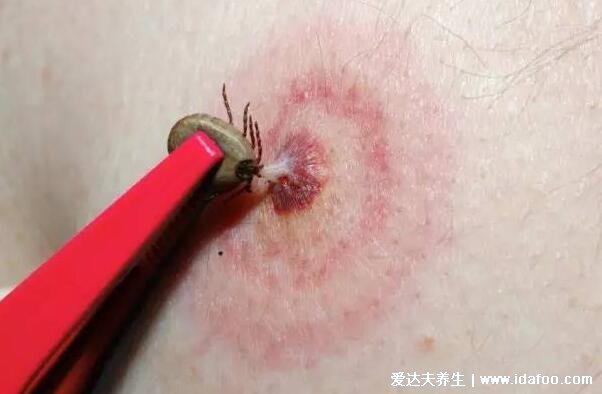 蜱虫咬人后有什么症状，真实蜱虫叮咬后伤口图片