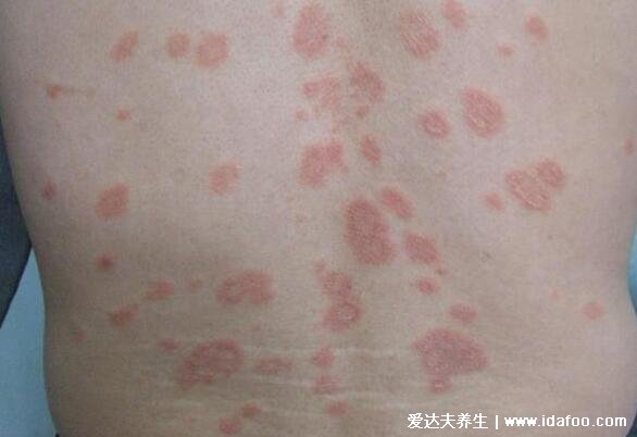 玫瑰糠疹图片初期症状，从一块母斑扩散到全身4-8周可自愈