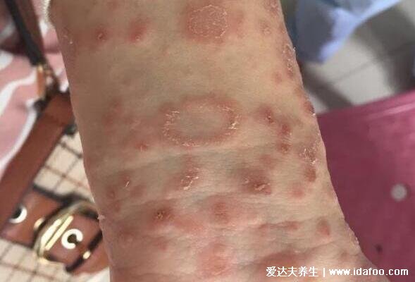 玫瑰糠疹图片初期症状，从一块母斑扩散到全身4-8周可自愈