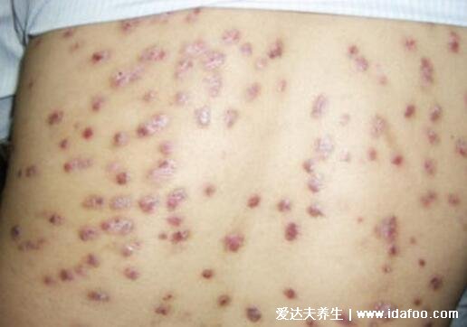 湿疹图片初期症状图片，急性湿疹最难防
