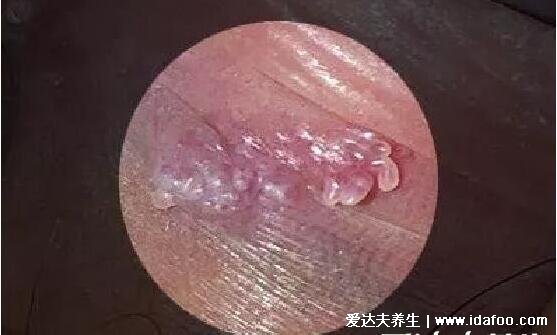 女性初期小疣体图片症状，米粒状丘疹相互融合成菜花/鸡冠状疣体