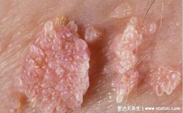 女性初期小疣体图片症状，米粒状丘疹相互融合成菜花/鸡冠状疣体