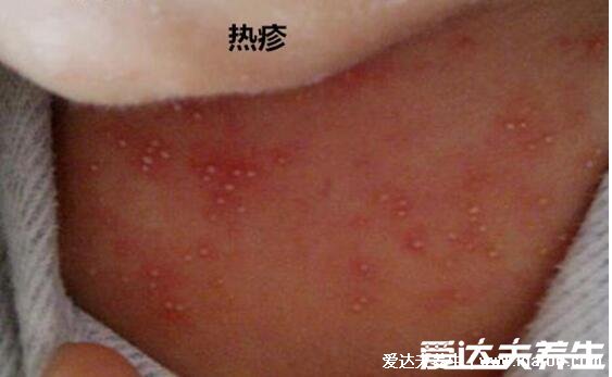 湿疹的图片和症状图片，五种常见类型剧烈瘙痒甚至糜烂