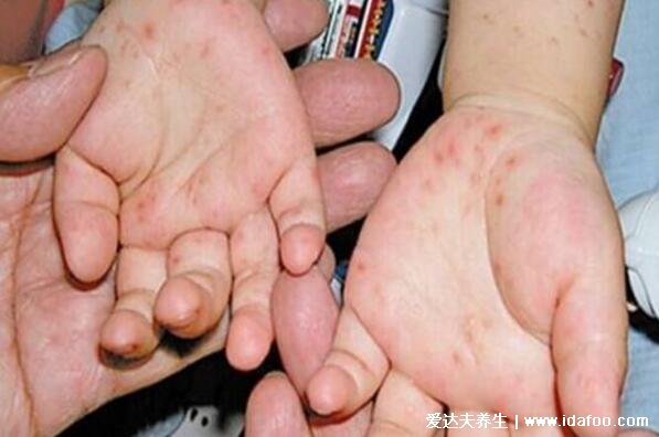 手足口病初期是小红点图片，轻症7天可自愈/警惕重症型非常严重