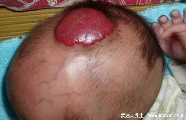 5种血管瘤图片症状，警惕在短期内明显增大的红色斑块(婴幼儿高发)