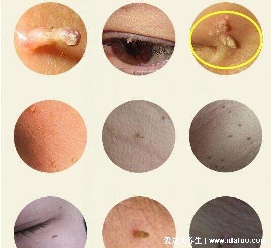 典型丝状疣初期图片，脸上有细长的丝状疣体会增大传染(HPV病毒所致)