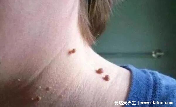 典型丝状疣初期图片，脸上有细长的丝状疣体会增大传染(HPV病毒所致)