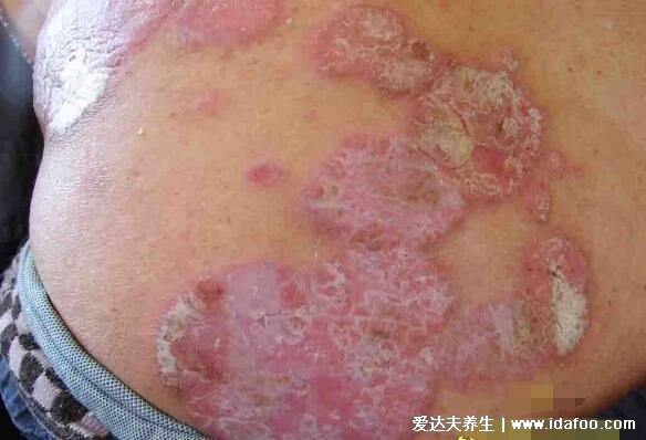 干皮癣早期图症状片,凸起的红色斑块有白色磷屑伴随剧烈瘙痒