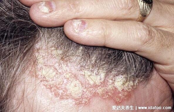 干皮癣早期图症状片，凸起的红色斑块有白色磷屑伴随剧烈瘙痒