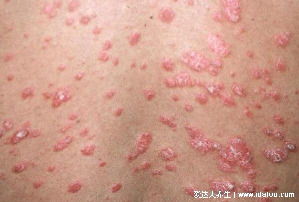 干皮癣早期图症状片，凸起的红色斑块有白色磷屑伴随剧烈瘙痒